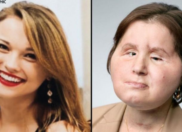 Korban Bunuh Diri Dapat 'Kesempatan Hidup Kedua' Berkat Transplantasi Wajah