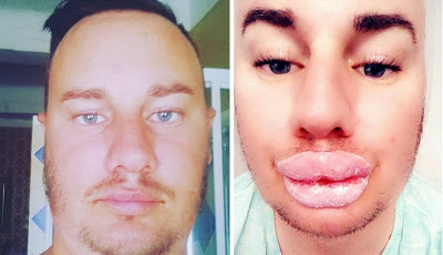 Ingin Mirip Marilyn Monroe, Lihat Perubahan Bibir Pria Ini