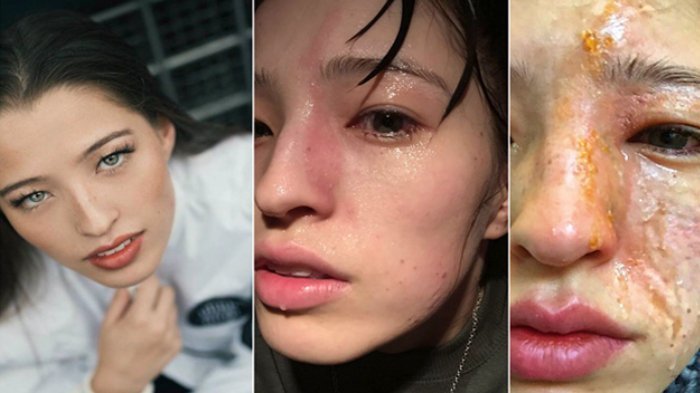 Wajah Wanita Cantik ini Bakal Cacat Seumur Hidup Usai Terkena Minyak