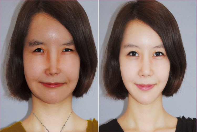 Wajah Cewek-Cewek Korea Sebelum dan Sesudah Dipermak
