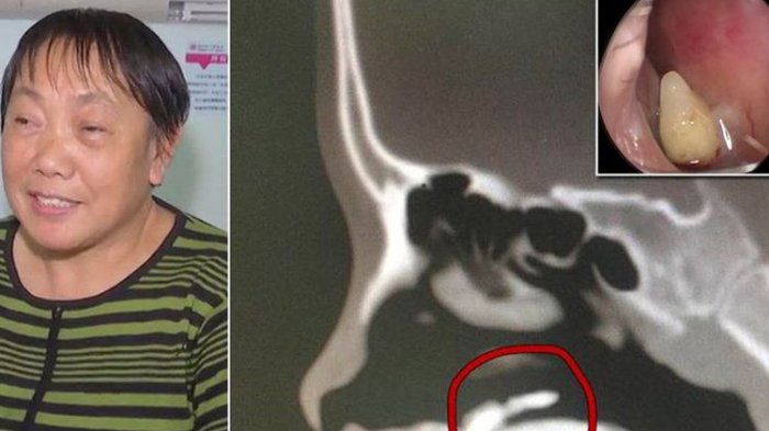 Hidung Wanita ini Sering Tersumbat Bertahun-tahun, Setelah Diperiksa Dokter Temukan Hal Langka