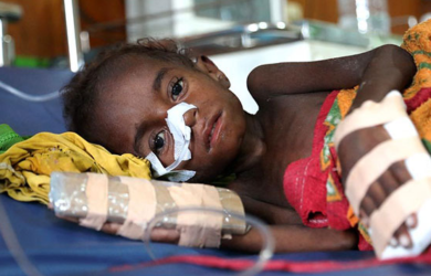 Gizi Buruk di Asmat Papua, Ini Ternyata Penyebabnya