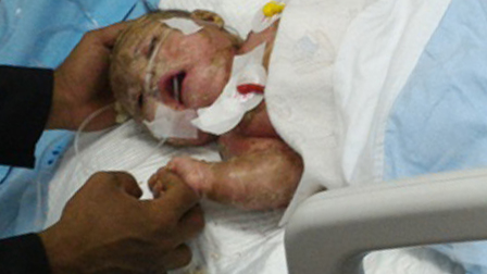 Sakit Bayi Hafizi Biasanya Terjadi pada Orang Dewasa