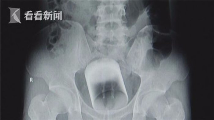 Dokter Kaget Temukan Gelas dalam Bagian Vital, Ternyata Pria ini...