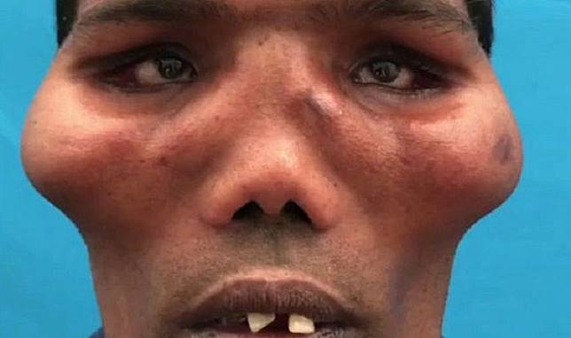 20 Tahun Pria 'Berwajah Singa' Ini Hidup, Setelah Operasi Tampilannya Jadi Bikin Orang Pangling
