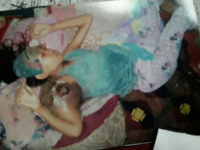 Derita Tumor Ganas, Murid SD Asal Tembilahan ini Hanya Bisa Terbaring Tak Berdaya