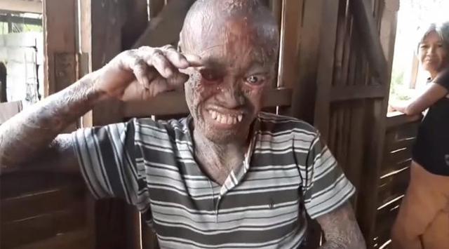 Pria Ini Dijuluki Hantu oleh Warga Karena Idap Penyakit Aneh