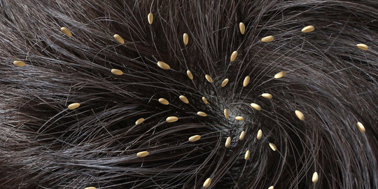 Karena Obat Kutu Rambut, 2 Kakak Beradik Meninggal Keracunan