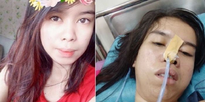 Gara-gara Kecanduan Main Mobile Legend, Remaja Putri Ini Mengalami Stroke