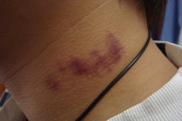 Tewas karena Dicupang Suami, Kalian Harus Kenali Bahayanya