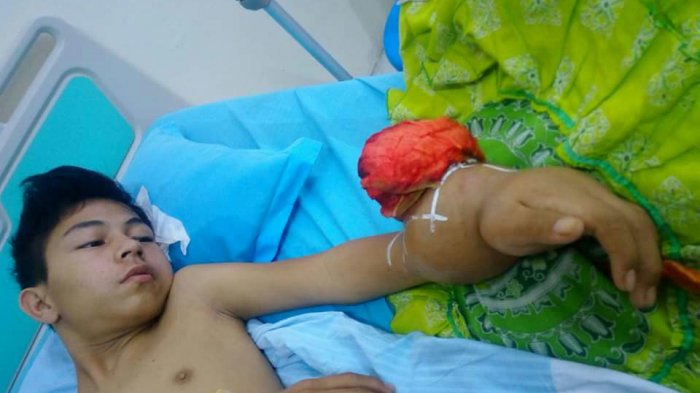 Divonis Kanker Stadium 4, Remaja Rohul Ini Butuh Uluran Tangan