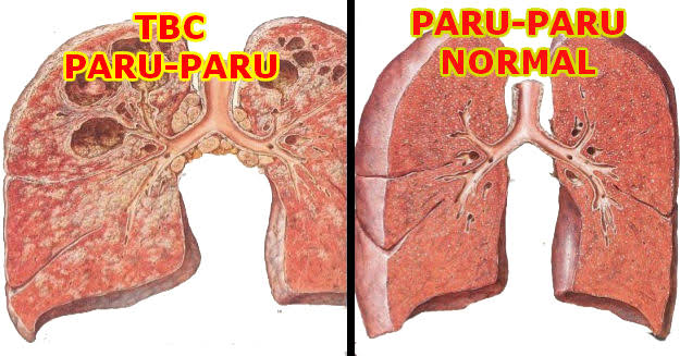 Dinkes Inhil Komitmen Lakukan Penanggulangan TBC Menuju Eliminasi 2030