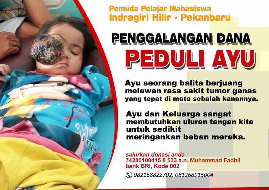 Ringankan Beban Ayu Penderita Kanker Mata Ganas, Sejumlah Pemuda Dan Pelajar Inhil Di Pekanbaru Galang Dana
