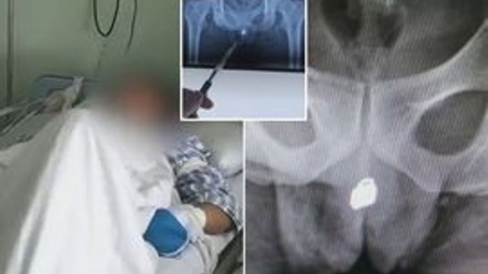 Hanya Demi Kepuasan! Naas, Gembok Kecil ini Akhirnya Bersarang di Kandung Kemihnya