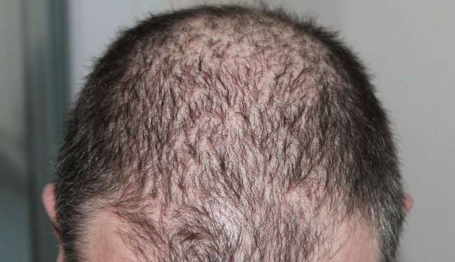 Cara Sederhana Cegah Kerontokan dan Kebotakan Rambut