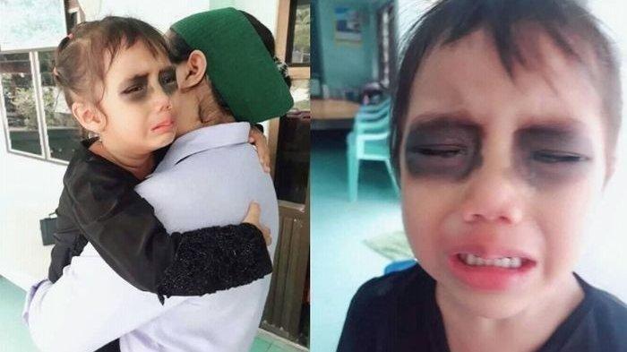 Bocah ini Menangis Meraung Lihat Matanya Menghitam, ini Penyebabnya