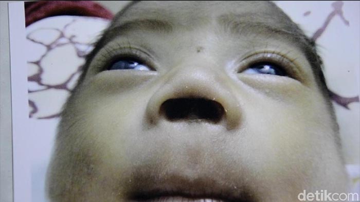 Diduga Korban Malpraktik, Sekat Hidung Bocah ini Hilang