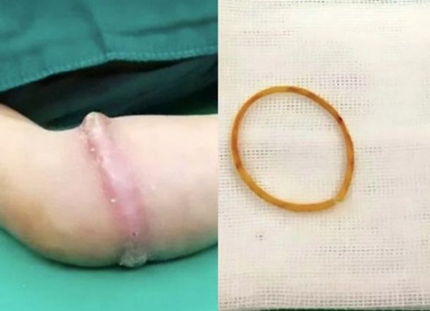 Akibat Enam Bulan Pakai Karet Gelang, Lihat Lengan Bocah Ini