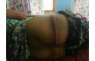MENGERIKAN! Lagi Buang Air Besar, Tiba-tiba Bokong Ibu Ini Digigit Buaya