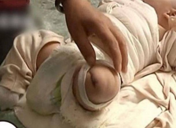 Perawat Lupa Matikan Pengering Rambut, Kaki Bayi Malang Ini Harus Diamputasi