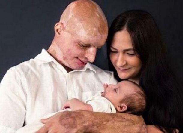 Buta Akibat Siraman Cairan Asam Pacar, Daniel Temukan Cinta Baru dari Perawat