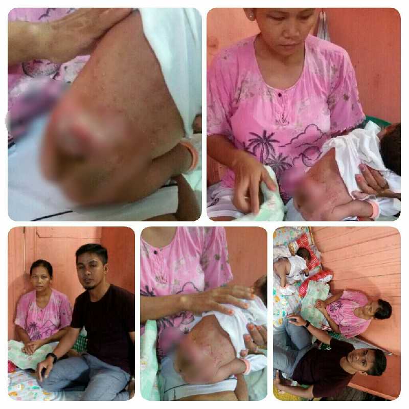 Rizky, Bayi Asal Inhil Penderita Kelainan Tulang Belakang Butuh Uluran Tangan