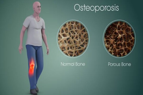 Hari Osteoporosis, Kadinkes Inhil: Mari Menjaga Kesehatan Tulang