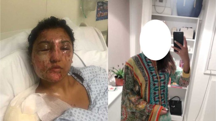 Sempat Cacat Wajah karena Siraman Air Keras, Kini Wanita Ini Jadi Cantik Banget!