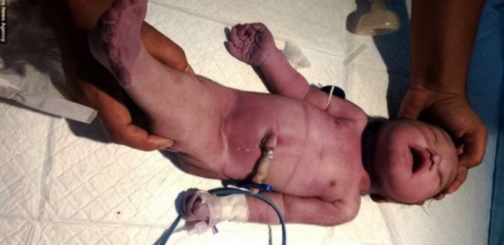 Bayi Ini Lahir dengan Fisik Seperti Ikan Duyung