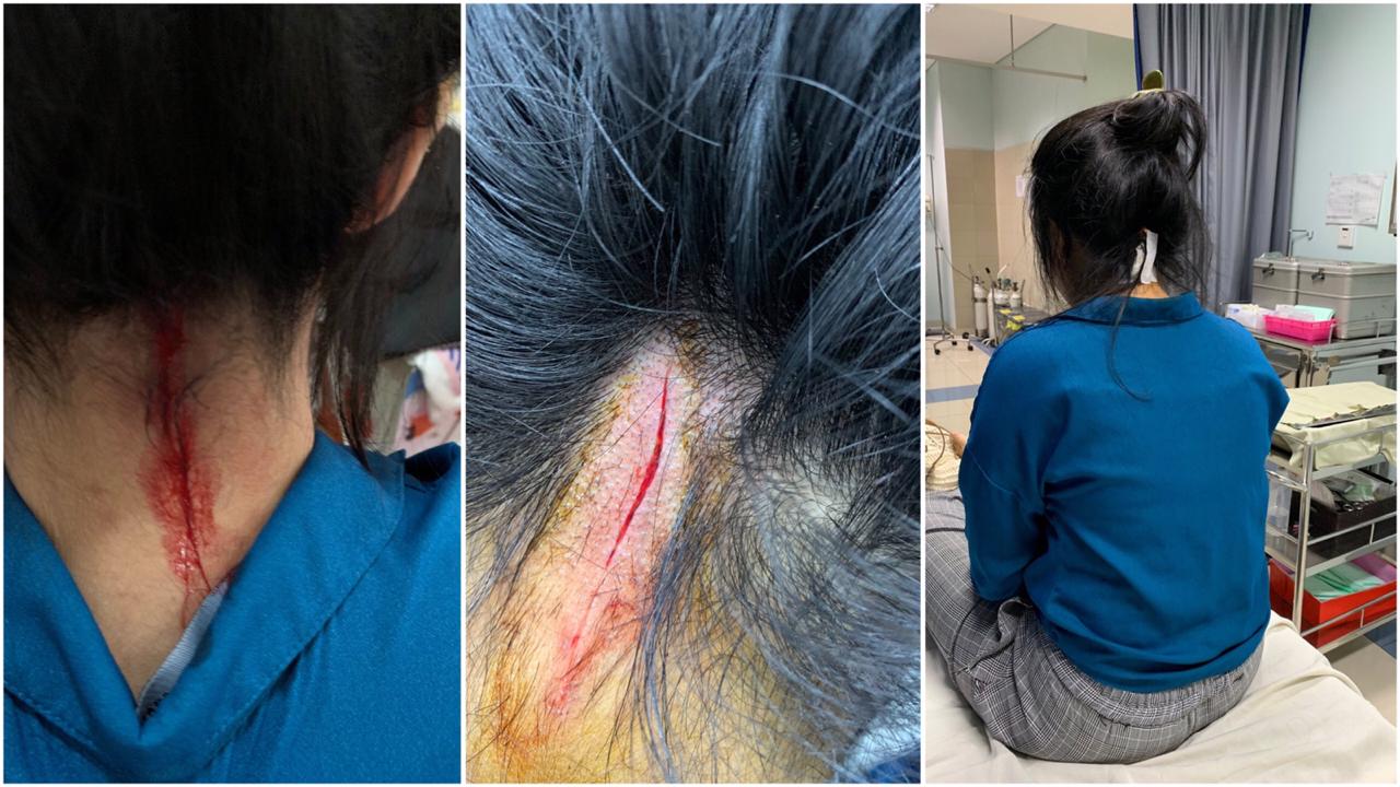 SADIS! Tengkuk Perempuan Cantik ini Disilet saat Jalan, Pelakunya Ternyata