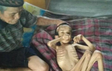 PILU... Tinggal Tulang dan Kulit, 10 Tahun Remaja Ini Menderita Gizi Buruk