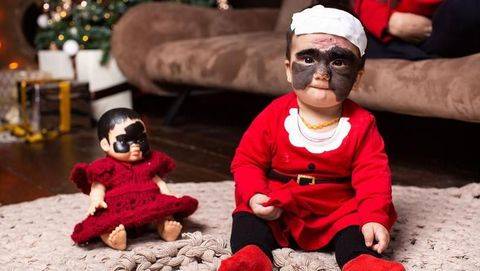 Operasi Tanda Lahir 'Batman' di Wajah Bayi Ini Tanpa Bekas Luka
