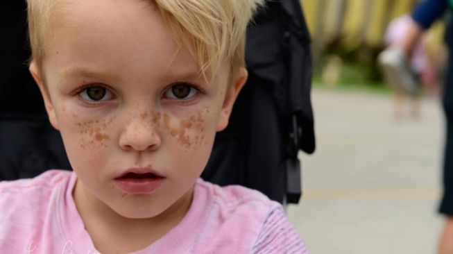 Derita Penyakit Langka yang Tak Bisa Sembuh, Kulit Bocah Ini Sering Berdarah