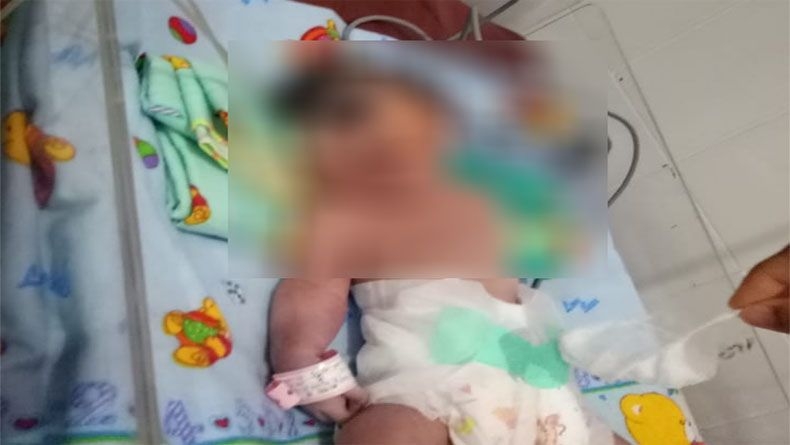 Bayi Bermata Satu yang Lahir di Madina Meninggal Dunia