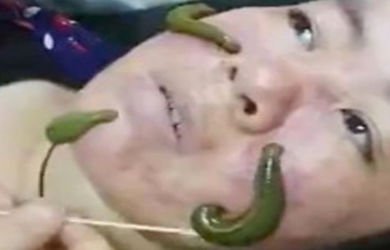 Frustasi Jerawat Tak Kunjung Sembuh, Wanita Ini Nekat Usir Jerawat Pakai Lintah