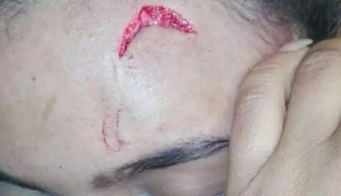 Dahi Model Luka Menganga Dipukuli Istri Presiden