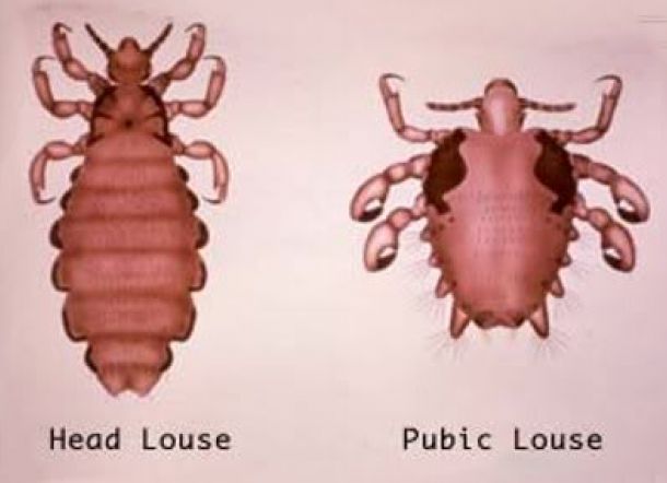 Waspada Banyak Kutu Rambut di Area Kemaluan