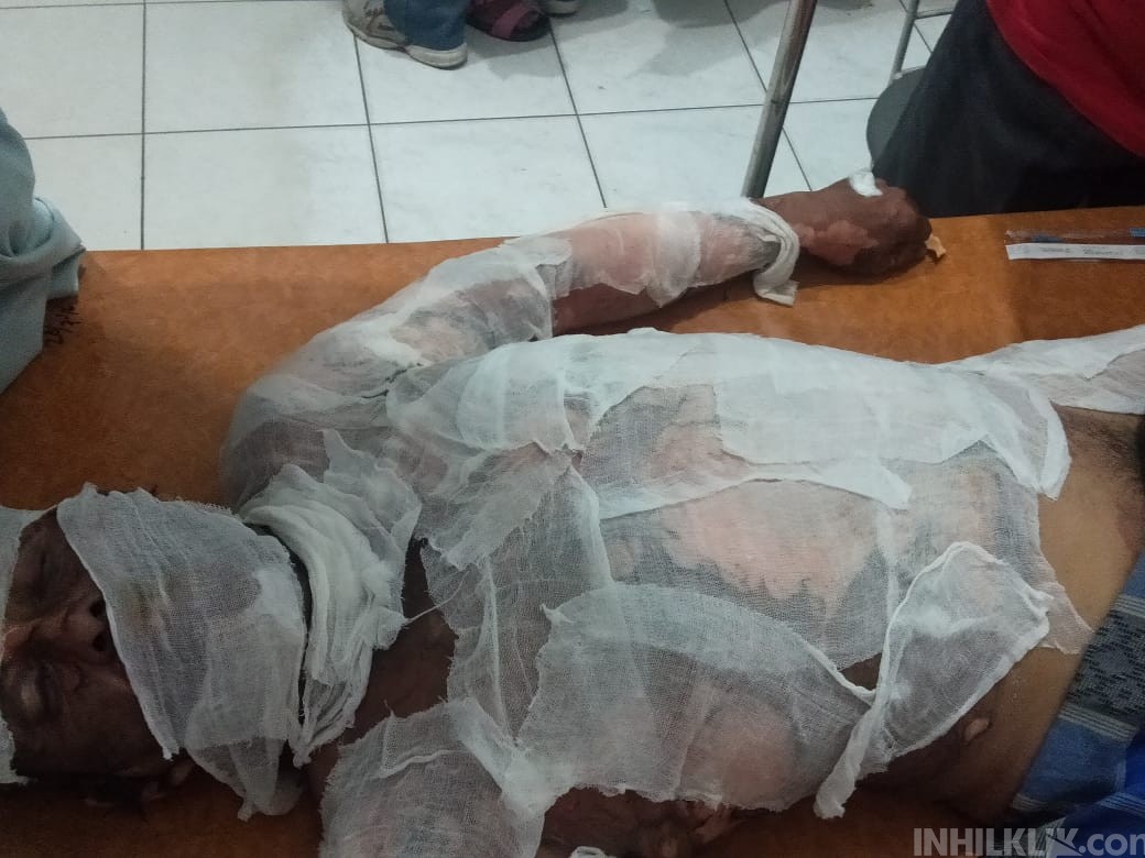 Cekcok Mulut Gara-gara Lembu, Isteri Spontan Bakar Suami Pakai Bensin