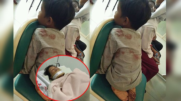 Demi Selamatkan Buah Hatinya, Sumarni Rela Lehernya Ditebas Suami