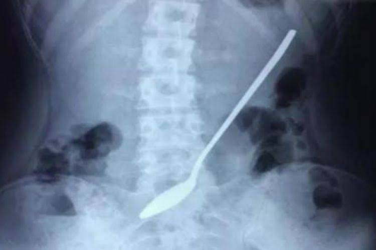 Remaja Ini Telan Sendok 20 Cm