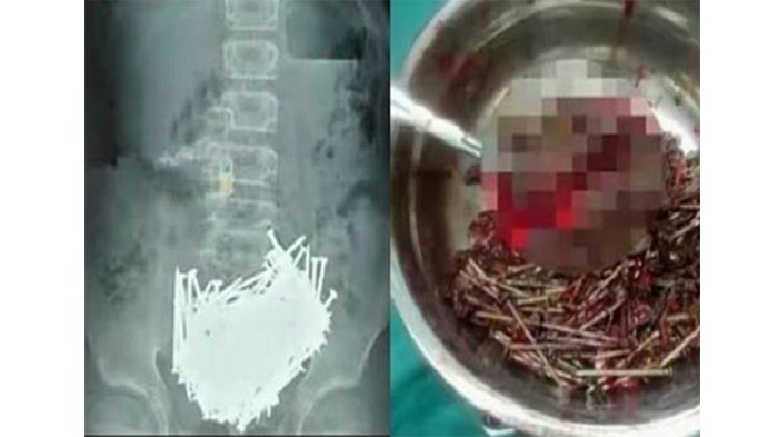Sebanyak 639 Paku Bersarang di Perut Pria ini