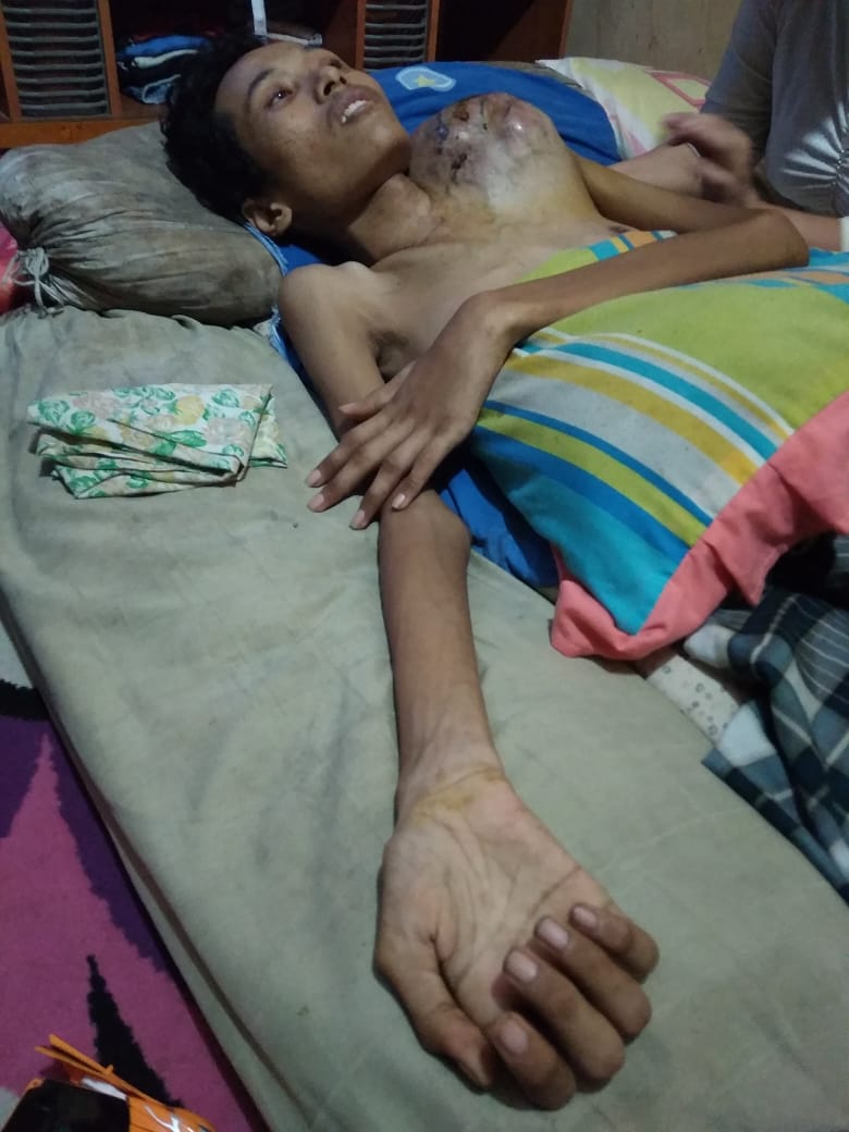 Rafii Putra, Penderita Osteosarcoma Asal Teluk Pinang, Inhil Butuh Uluran Tangan